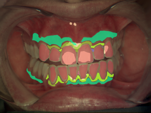 False color image render of a spectral image exhibiting attached gingiva, calculus, enamel, gingivitis, marginal gingiva, oral mucosa, plaque and specular reflection