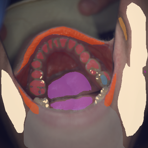 False color image render of a spectral image exhibiting enamel, hair, initial caries, lip, mole, oral mucosa, out of focus area, plastic, skin, specular reflection and tongue