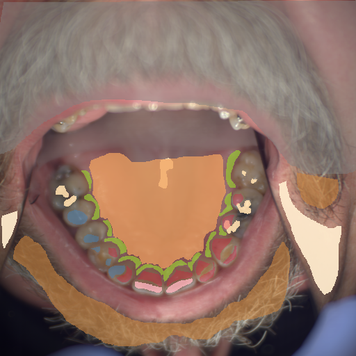 False color image render of a spectral image exhibiting attrition/erosion, enamel, hair, hard palate, marginal gingiva, out of focus area, plastic, skin and specular reflection