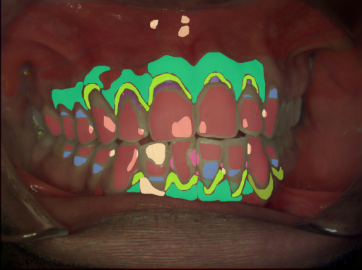 False color image render of a spectral image exhibiting attached gingiva, calculus, enamel, fluorosis, gingivitis, initial caries, marginal gingiva, oral mucosa, pigmentation, plaque, root and specular reflection