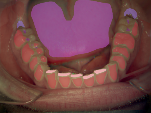 False color image render of a spectral image exhibiting attrition/erosion, enamel, inflammation, initial caries, oral mucosa and tongue