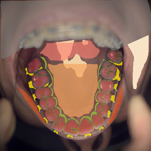 False color image render of a spectral image exhibiting enamel, hard palate, lip, marginal gingiva, metal, out of focus area, skin, soft palate, specular reflection and stain
