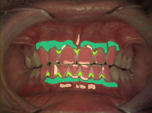 False color image render of a spectral image exhibiting attached gingiva, calculus, enamel, gingivitis, oral mucosa and specular reflection