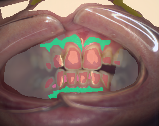 False color image render of a spectral image exhibiting attached gingiva, calculus, enamel, hair, oral mucosa, out of focus area, shadow/noise, skin, specular reflection and stain