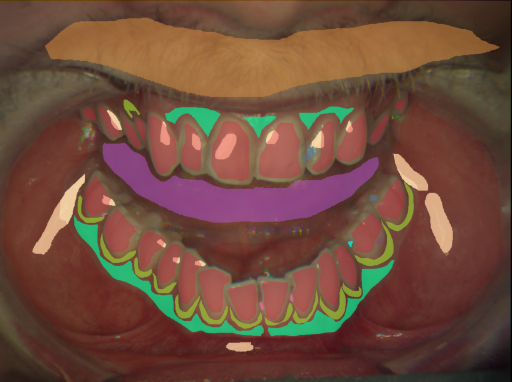 False color image render of a spectral image exhibiting attached gingiva, calculus, dentine caries, enamel, hair, initial caries, marginal gingiva, oral mucosa, plastic, specular reflection, stain and tongue