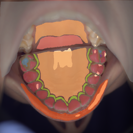 False color image render of a spectral image exhibiting enamel, hard palate, initial caries, lip, marginal gingiva, out of focus area, plastic, soft palate, specular reflection and stain