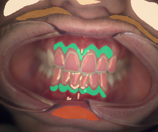 False color image render of a spectral image exhibiting attached gingiva, enamel, hair, lip, oral mucosa, skin and specular reflection