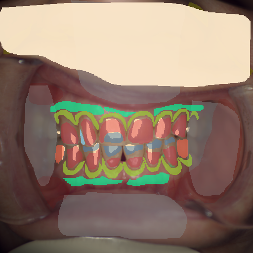 False color image render of a spectral image exhibiting attached gingiva, enamel, marginal gingiva, microfracture, oral mucosa, out of focus area, plastic, prosthetics, root, shadow/noise, skin and specular reflection