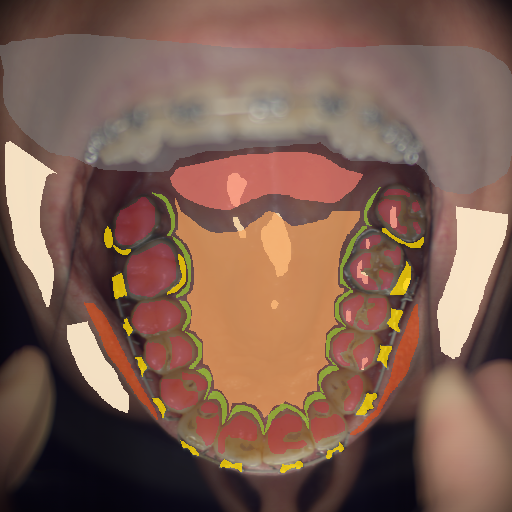 False color image render of a spectral image exhibiting enamel, hard palate, lip, marginal gingiva, metal, out of focus area, skin, soft palate, specular reflection and stain