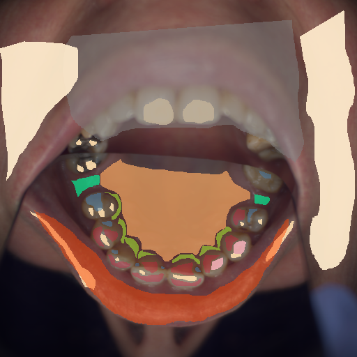 False color image render of a spectral image exhibiting attached gingiva, attrition/erosion, enamel, hard palate, lip, marginal gingiva, out of focus area, plastic, skin, specular reflection and stain