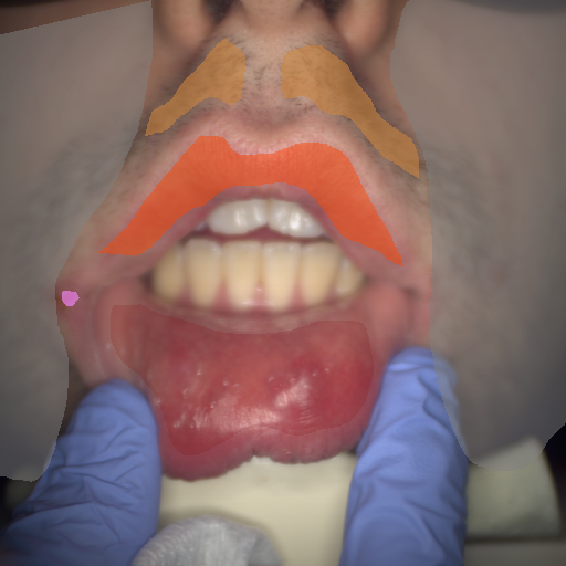 False color image render of a spectral image exhibiting hair, lip, oral mucosa, out of focus area and ulcer