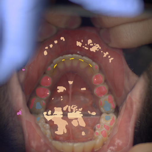 False color image render of a spectral image exhibiting enamel, metal, oral mucosa, plastic, specular reflection and ulcer