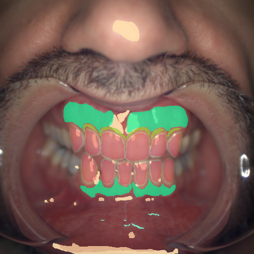 False color image render of a spectral image exhibiting attached gingiva, blood vessel, enamel, marginal gingiva, oral mucosa, specular reflection and stain
