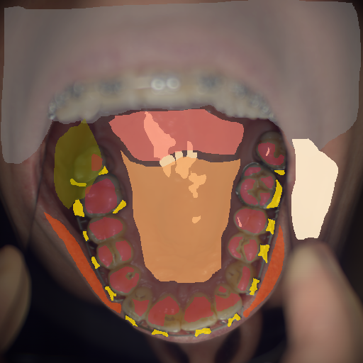 False color image render of a spectral image exhibiting enamel, hard palate, lip, metal, out of focus area, shadow/noise, skin, soft palate, specular reflection and stain