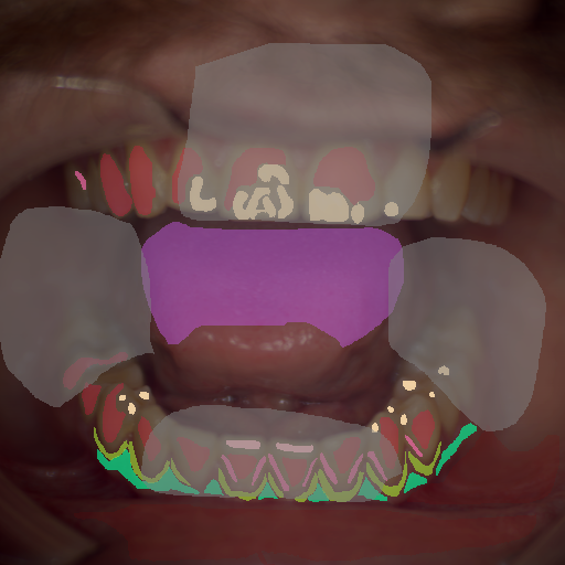 False color image render of a spectral image exhibiting attached gingiva, attrition/erosion, calculus, enamel, marginal gingiva, oral mucosa, out of focus area, specular reflection and tongue
