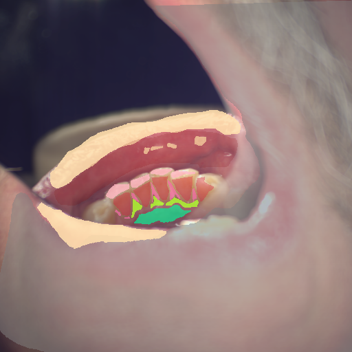 False color image render of a spectral image exhibiting attached gingiva, attrition/erosion, calculus, enamel, gingivitis, oral mucosa, out of focus area and specular reflection