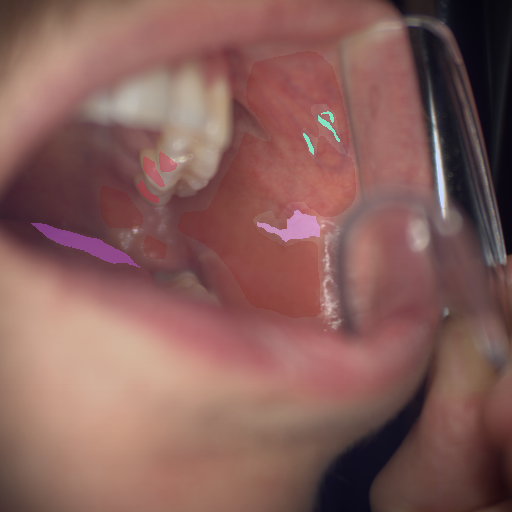 False color image render of a spectral image exhibiting blood vessel, enamel, leukoplakia, oral mucosa and tongue