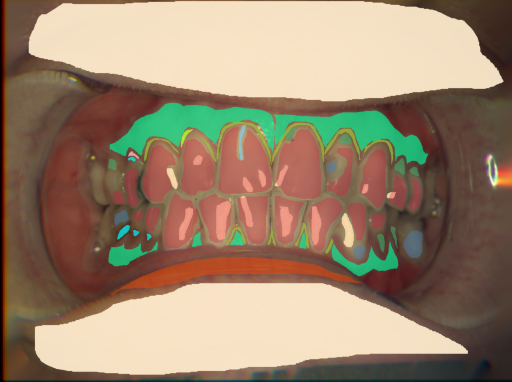 False color image render of a spectral image exhibiting attached gingiva, attrition/erosion, dentine caries, enamel, gingivitis, lip, marginal gingiva, microfracture, oral mucosa, plastic, root, skin and specular reflection