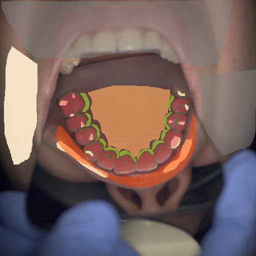 False color image render of a spectral image exhibiting enamel, hard palate, lip, marginal gingiva, out of focus area, skin, specular reflection and stain