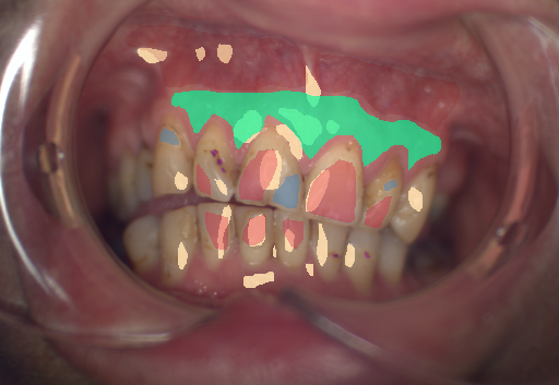 False color image render of a spectral image exhibiting attached gingiva, enamel, initial caries, oral mucosa, plastic and specular reflection