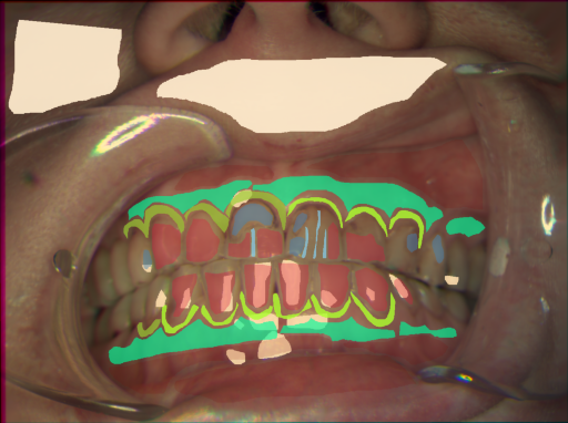 False color image render of a spectral image exhibiting attached gingiva, enamel, gingivitis, marginal gingiva, microfracture, oral mucosa, plastic, skin, specular reflection and stain
