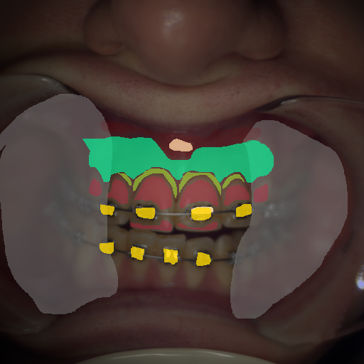 False color image render of a spectral image exhibiting attached gingiva, enamel, marginal gingiva, metal, oral mucosa, out of focus area and specular reflection