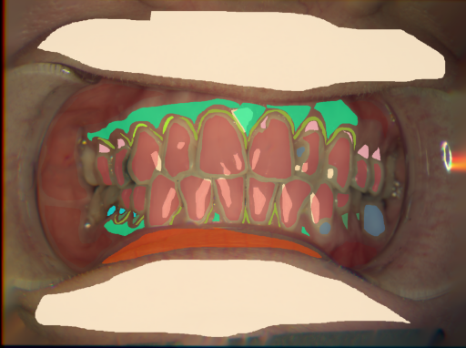False color image render of a spectral image exhibiting attached gingiva, attrition/erosion, dentine caries, enamel, gingivitis, lip, marginal gingiva, oral mucosa, plastic, root, skin and specular reflection