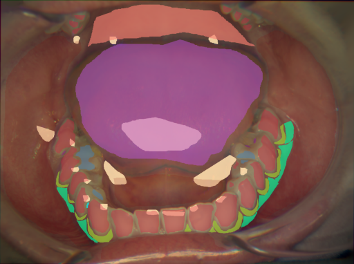False color image render of a spectral image exhibiting attached gingiva, dentine caries, enamel, initial caries, marginal gingiva, oral mucosa, plastic, soft palate, specular reflection and tongue