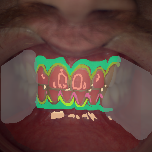 False color image render of a spectral image exhibiting attached gingiva, calculus, enamel, gingivitis, marginal gingiva, oral mucosa, out of focus area and specular reflection