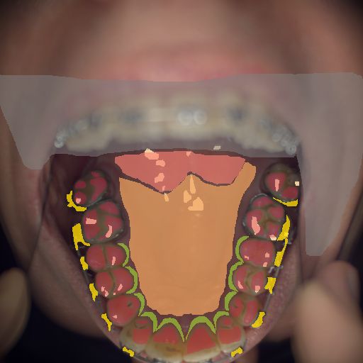 False color image render of a spectral image exhibiting enamel, hard palate, marginal gingiva, metal, out of focus area, soft palate, specular reflection and stain