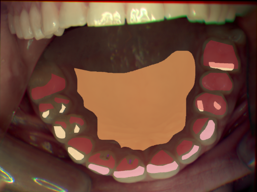 False color image render of a spectral image exhibiting attrition/erosion, enamel, hard palate, initial caries and specular reflection