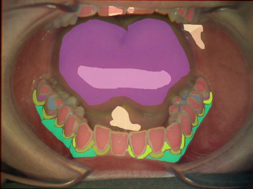 False color image render of a spectral image exhibiting attached gingiva, enamel, gingivitis, initial caries, marginal gingiva, oral mucosa, plastic, specular reflection and tongue