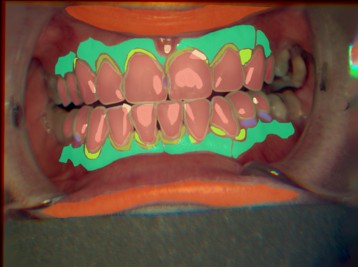 False color image render of a spectral image exhibiting attached gingiva, enamel, gingivitis, initial caries, lip, marginal gingiva, oral mucosa, plaque and specular reflection