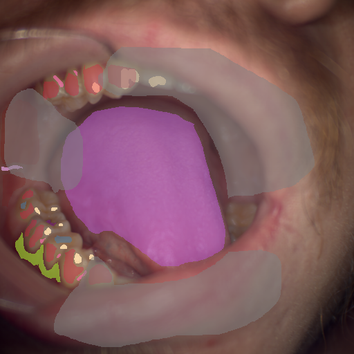 False color image render of a spectral image exhibiting calculus, enamel, initial caries, leukoplakia, marginal gingiva, oral mucosa, out of focus area, plastic, specular reflection and tongue