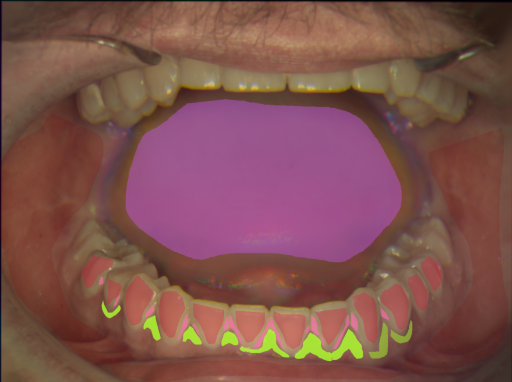 False color image render of a spectral image exhibiting calculus, enamel, gingivitis, marginal gingiva, oral mucosa and tongue