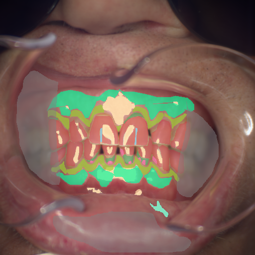 False color image render of a spectral image exhibiting attached gingiva, blood vessel, calculus, enamel, marginal gingiva, microfracture, oral mucosa, out of focus area, root, specular reflection and stain