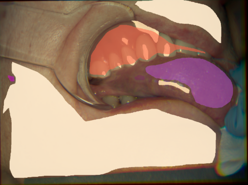 False color image render of a spectral image exhibiting malignant lesion, mole, prosthetics, skin, specular reflection and tongue