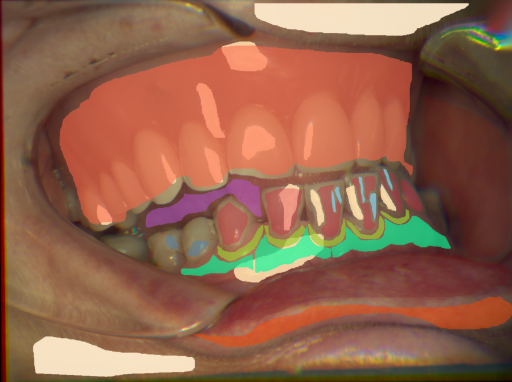 False color image render of a spectral image exhibiting attached gingiva, enamel, lip, marginal gingiva, microfracture, oral mucosa, plastic, prosthetics, skin, specular reflection, stain and tongue